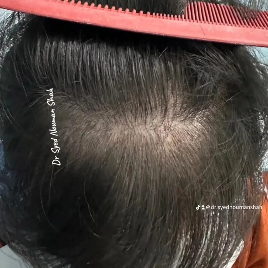Hair fall and hair restoration