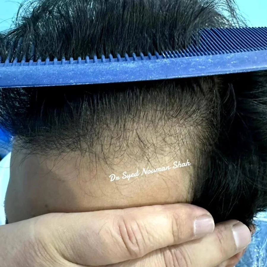 Hair fall and hair restoration