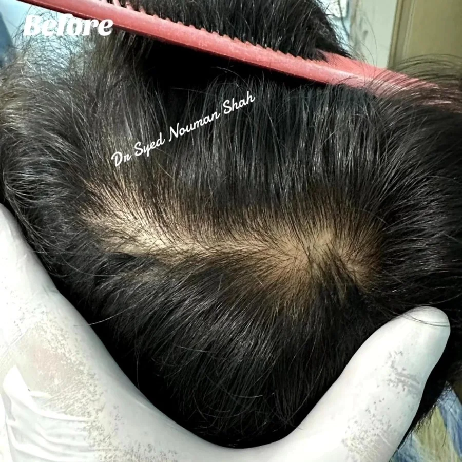 Hair fall and hair restoration
