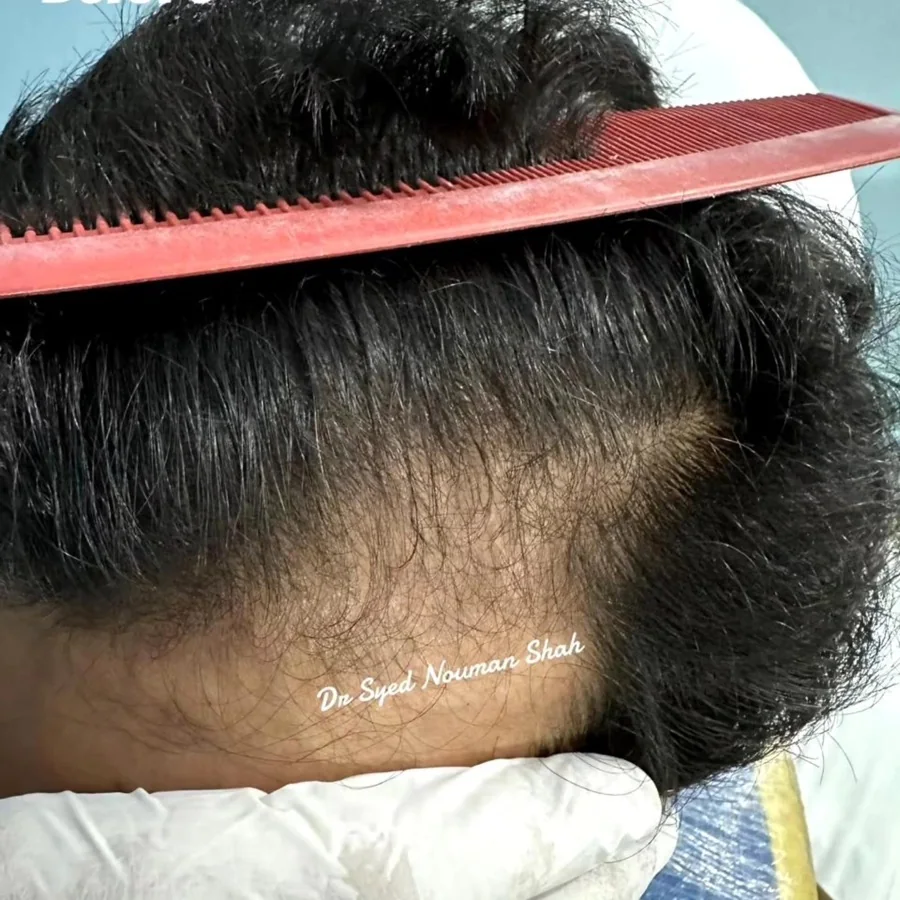 Hair fall and hair restoration