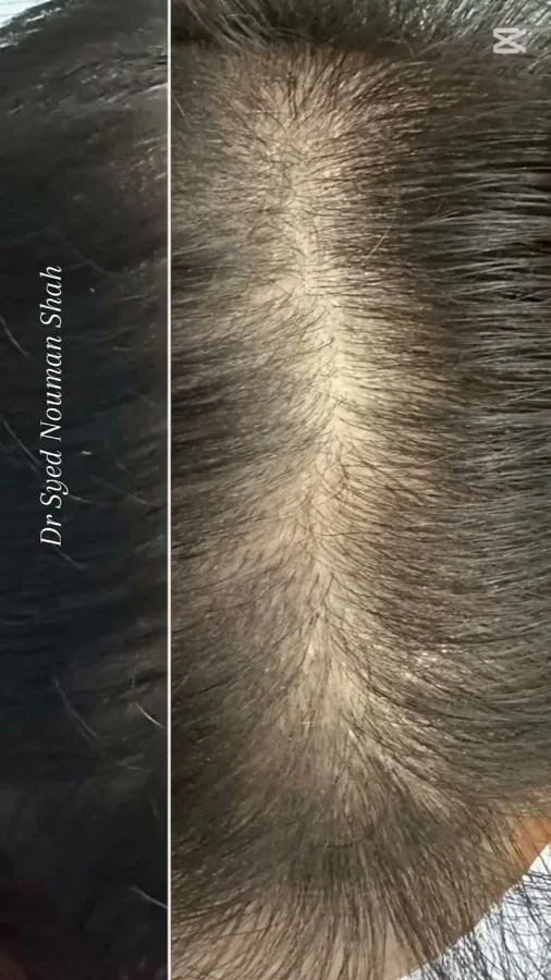 Hair fall and hair restoration