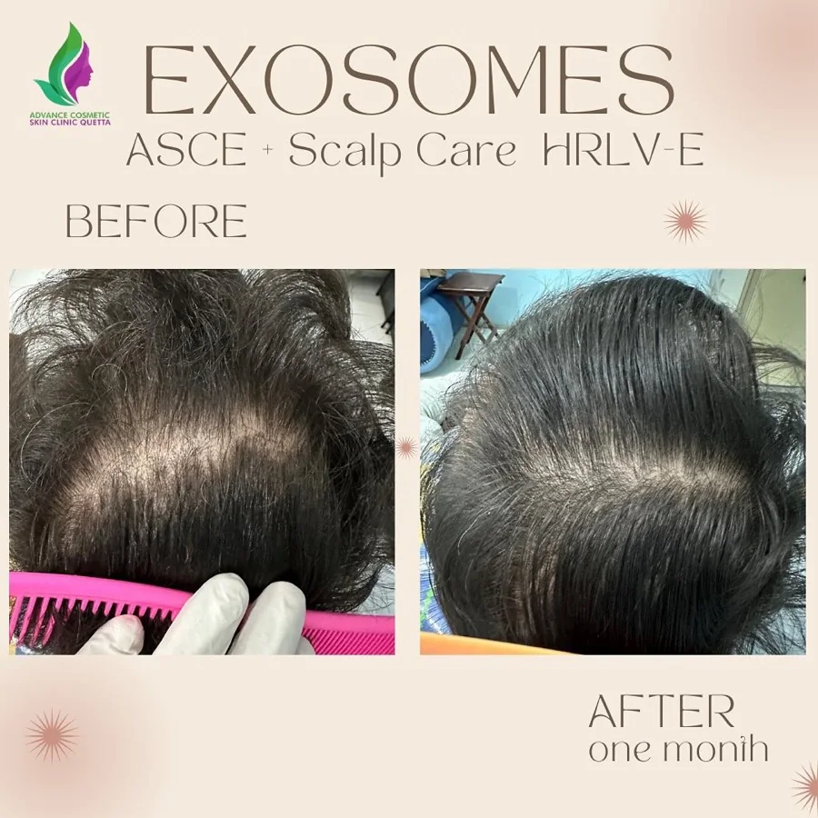 Hair fall and hair restoration