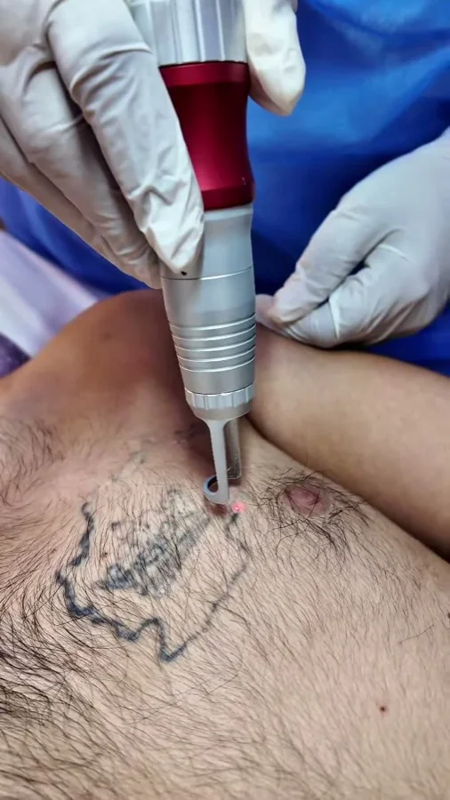 Tattoo removal