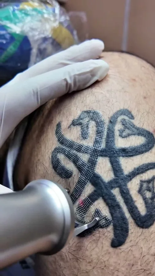Tattoo removal